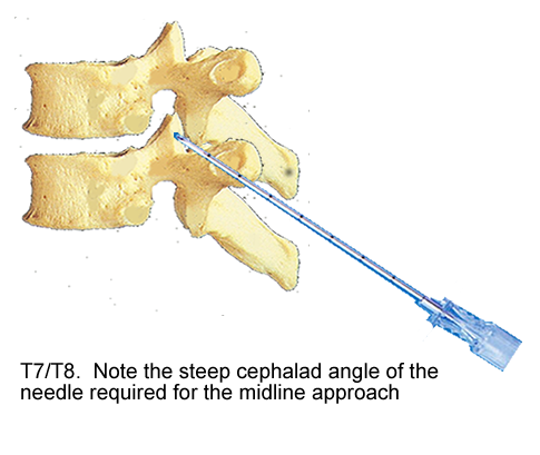 lateral